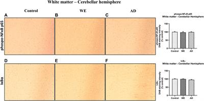 Upregulation of TLR4/MyD88 pathway in alcohol-induced Wernicke’s encephalopathy: Findings in preclinical models and in a postmortem human case